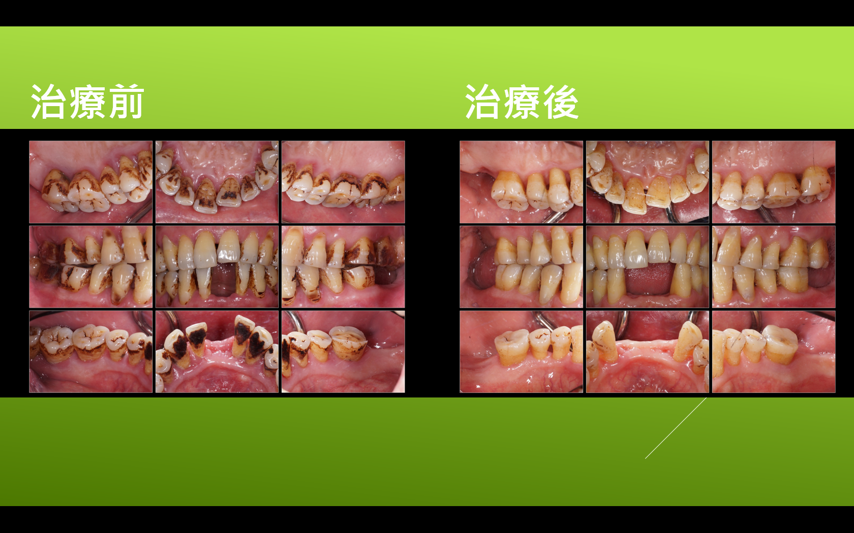 (三 牙周病科 牙周病就是牙齿「周围组织」的疾病,而牙齿