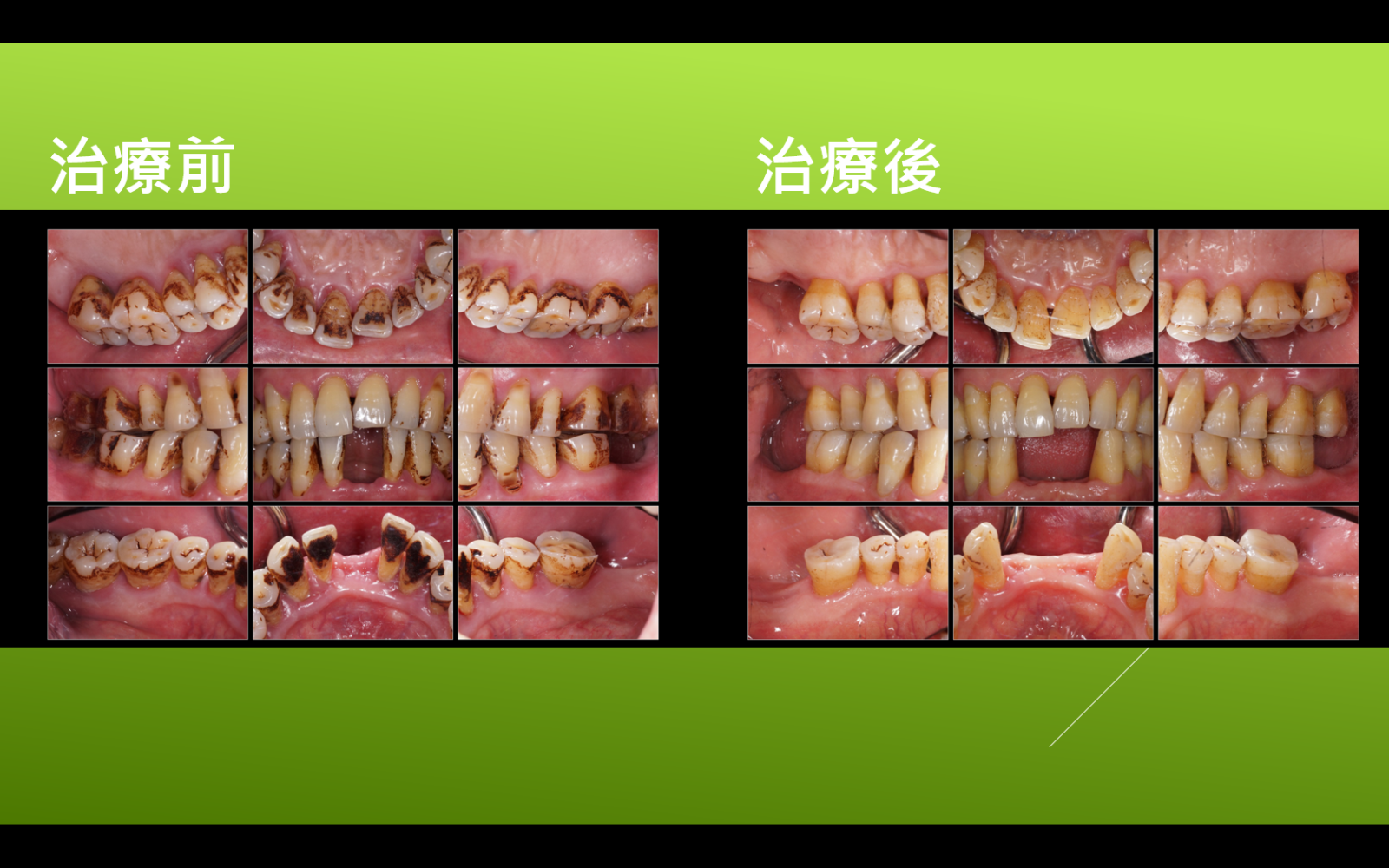 牙周病基礎深層治療圖片