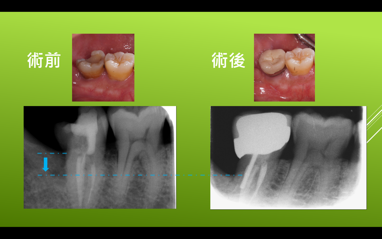 其他牙周相關手術牙冠增長術