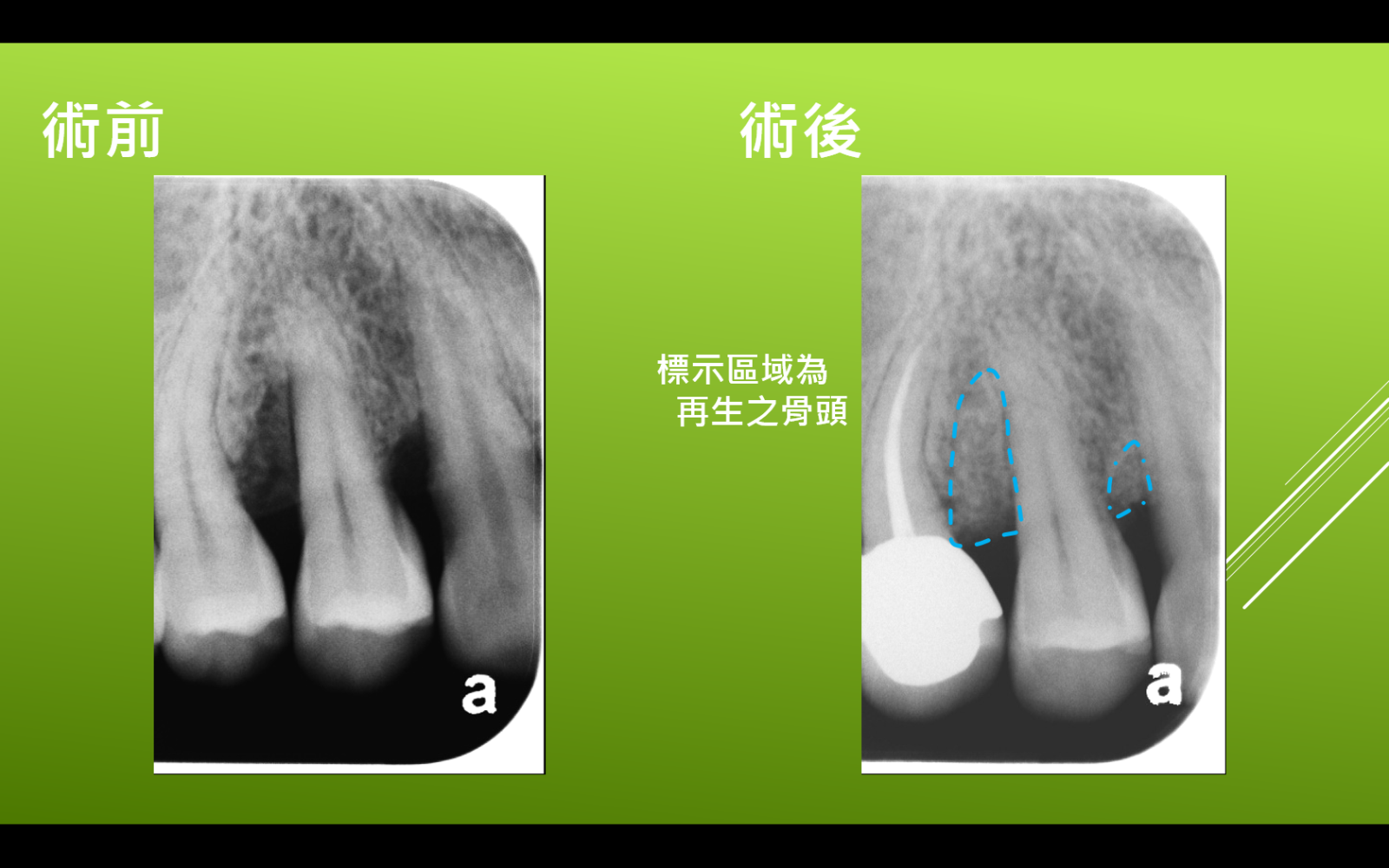 牙周病進階手術治療圖片