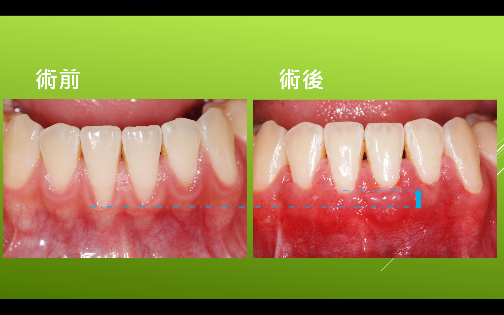 牙根覆蓋術-術前術後外觀比較