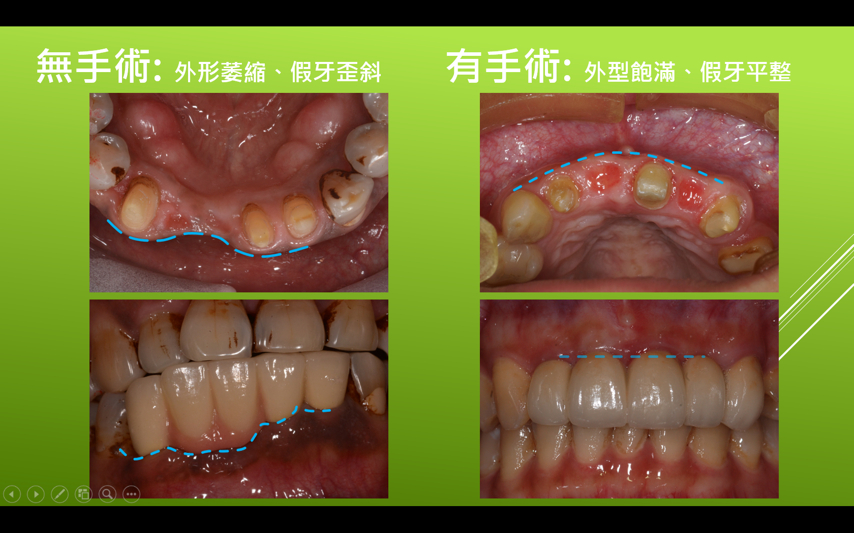 牙嵴保存術-無手術與有手術外觀比較